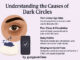 Dark circles hatane ke upay